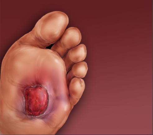 Diabetinė pėda: simptomai ir klasifikacija